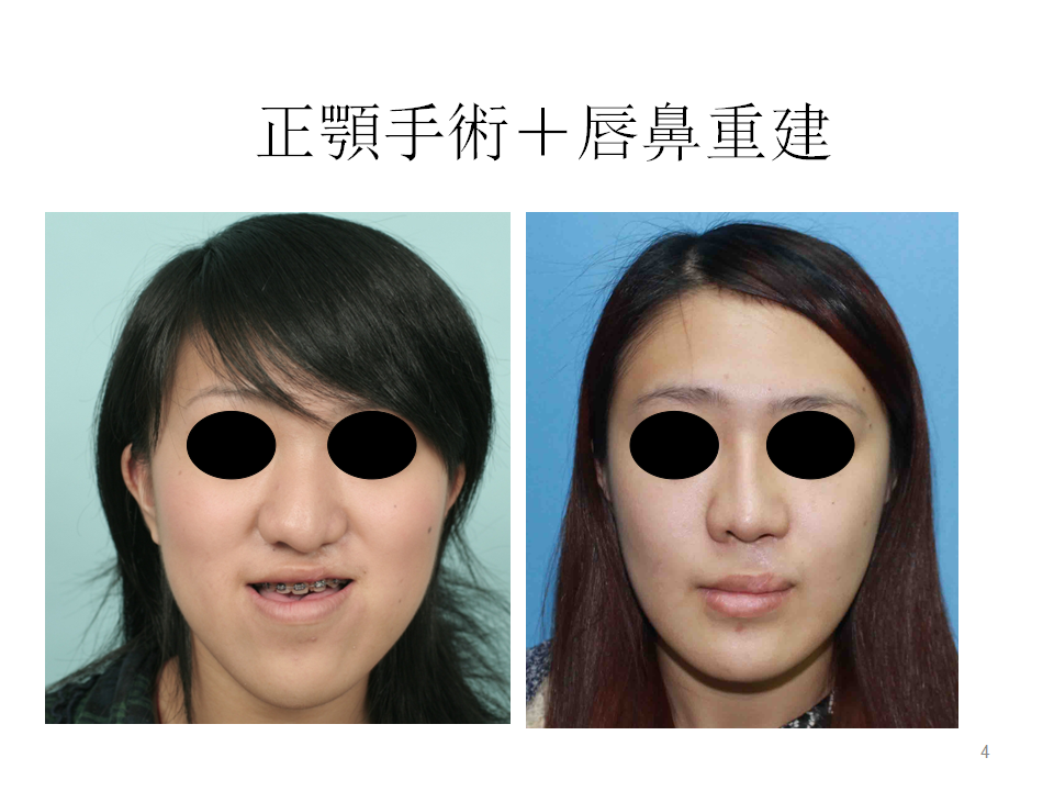 唇颚裂的大人修复 - 正颚手术-长庚整形外科主任-张呈